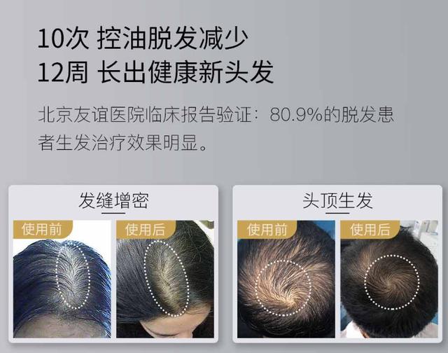 雷军管管？小米有品未做大就开始收智商税 众筹竟上架激光生发帽