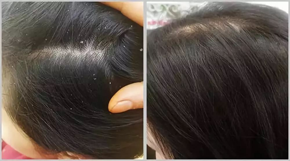 袁咏仪用的洗发水让人惊讶，比沙宣便宜，去屑控油又不输飘柔